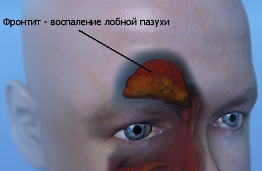 Гостра форма фронтиту