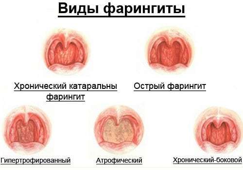 Гострий фарингіт симптоми і лікування у дорослих