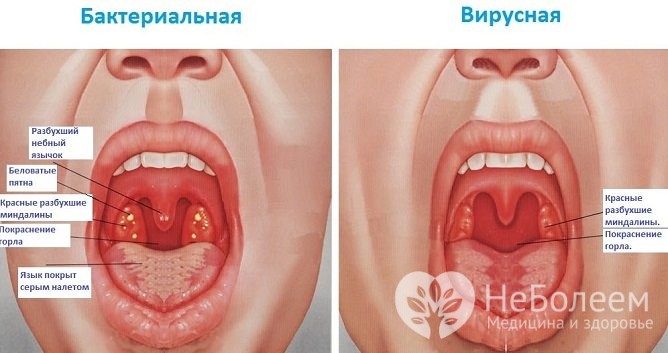 Гострий фарингіт симптоми і лікування у дорослих