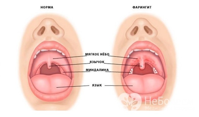 Гострий фарингіт симптоми і лікування у дорослих