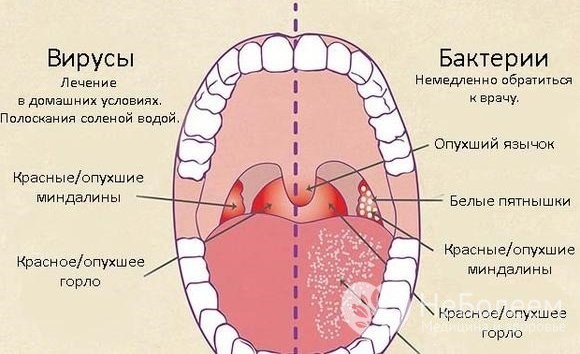 Гострий фарингіт симптоми і лікування у дорослих