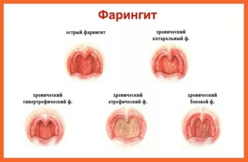 Гострий фарингіт у дітей симптоми і лікування
