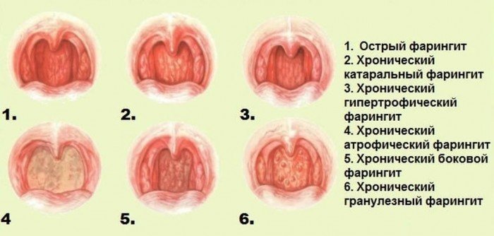 Гострий фарингіт у дітей симптоми і лікування
