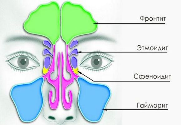Гострий фронтит що таке, симптоми і лікування у дорослих