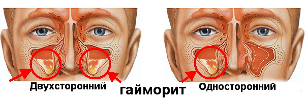 Гострий гайморит традиційні та сучасні методи лікування