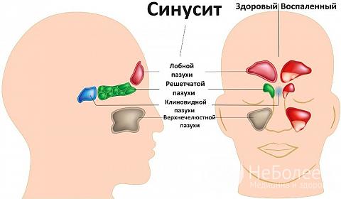 Гострий гайморит як проявляється види основні напрямки лікування