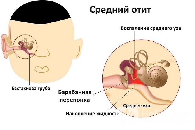 Гострий гнійний отит стадії симптоми і лікування захворювання