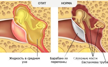 Гострий катаральний середній отит у дитини