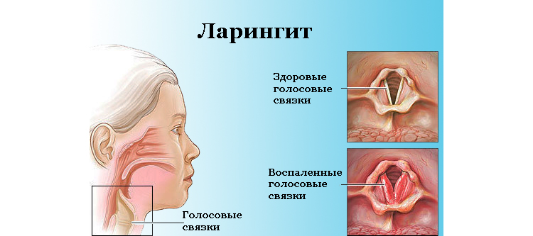 Гострий ларингіт – симптоми і лікування у дорослих