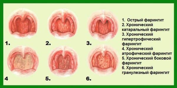 Гострий назофарингіт : причини, симптоми, діагностика, лікування
