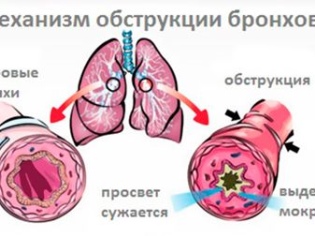 Гострий обструктивний бронхіт у дітей сучасні методи лікування