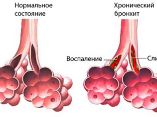 Гострий обструктивний бронхіт у дітей сучасні методи лікування