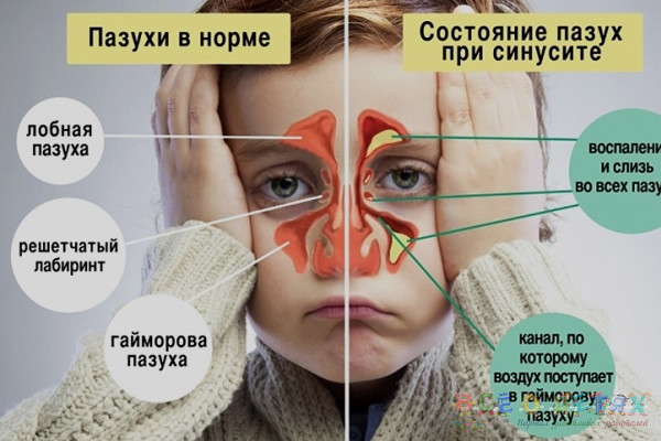 Гострий риніт – як лікувати у дорослих і дітей