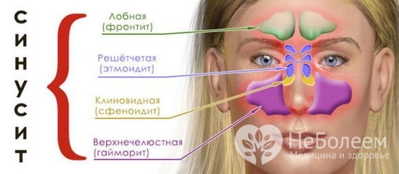 Гострий синусит – симптоми, лікування