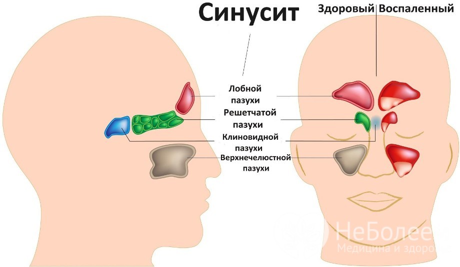 Гострий синусит – як і чим лікувати? Причини, симптоми та лікування гострого синуситу
