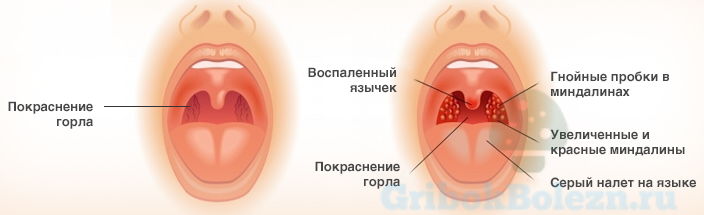 Грибкова ангіна (кандидозний тонзиліт): причини та особливості лікування