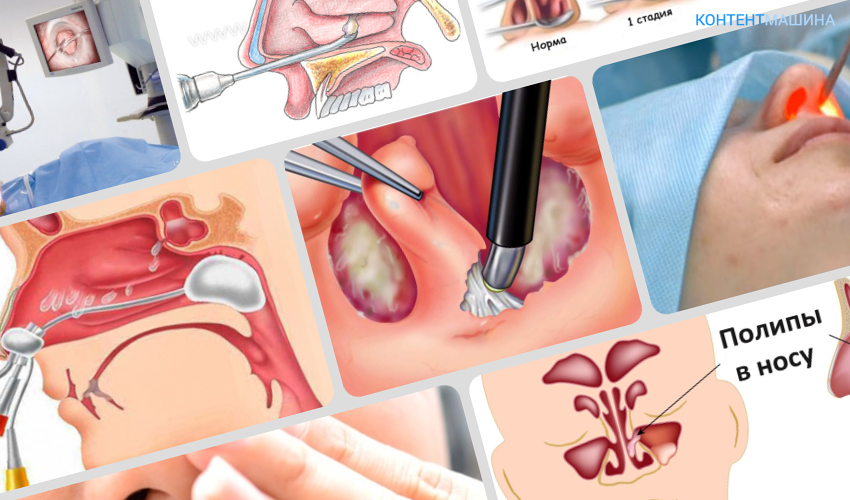 Хірургічні способи видалення поліпів носа у дітей