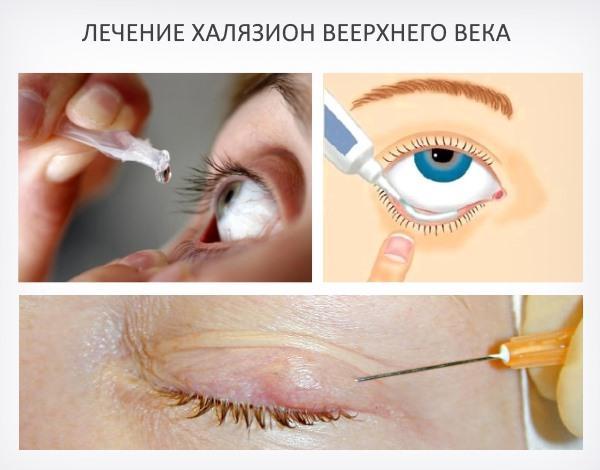 Халязіон верхнього століття лікування народними засобами