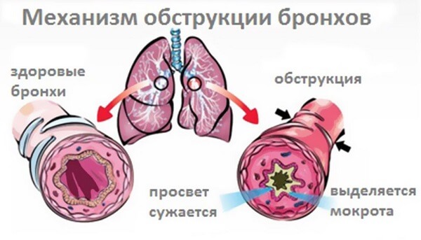 Характеристика та принципи лікування обструктивного бронхіту