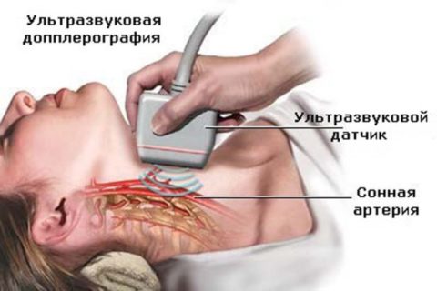 Холестеринові бляшки в судинах шиї лікування народними засобами Холестеринові бляшки в судинах шиї лікування народними засобами