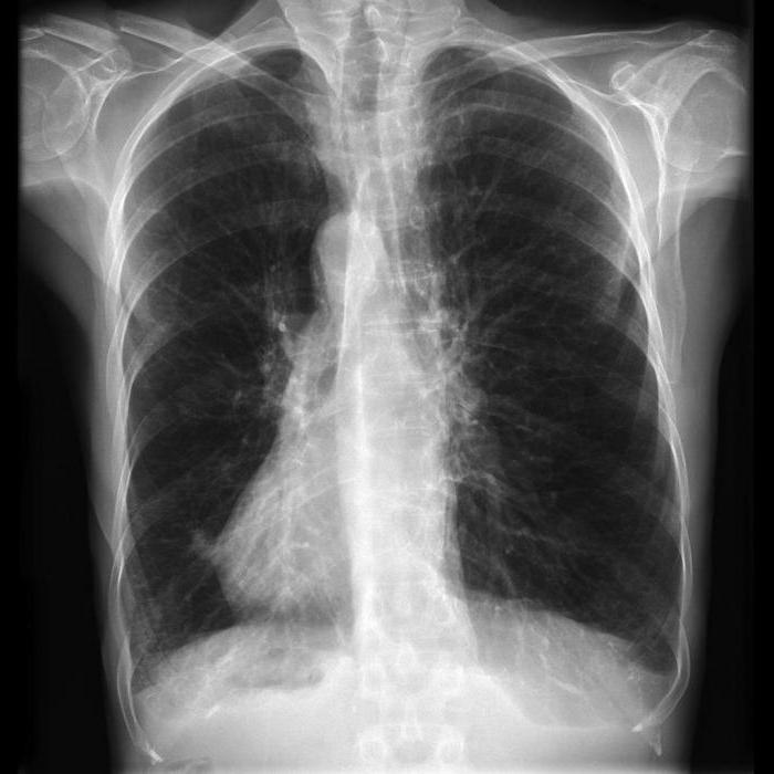 Хронічна обструктивна хвороба легень (ХОЗЛ)