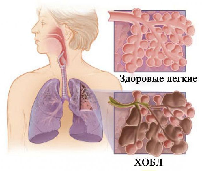 Хронічна обструктивна хвороба легень (ХОЗЛ)