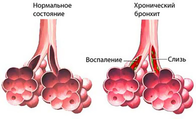 Хронічний бронхіт у дорослих і дітей симптоми і лікування