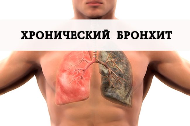 Хронічний бронхіт у дорослих і дітей симптоми і лікування