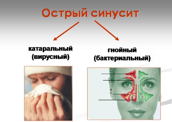 Хронічний етмоїдит – симптоми і лікування у дорослих, як лікувати