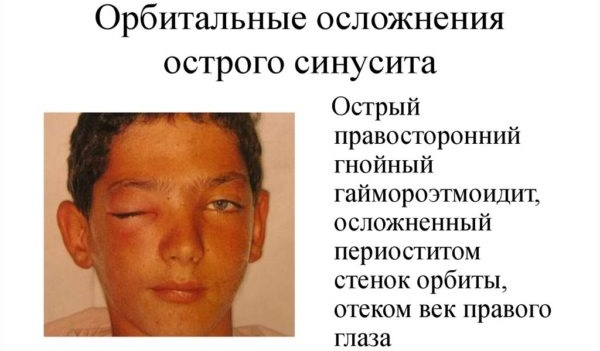Хронічний етмоїдит – симптоми і лікування у дорослих, як лікувати
