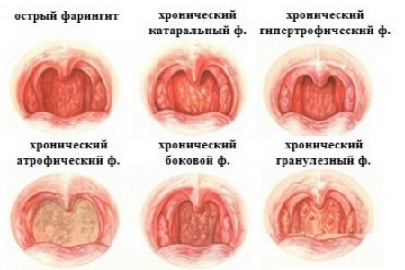 Хронічний фарингіт – симптоми і лікування у дорослих, як лікувати хронічний фарингіт
