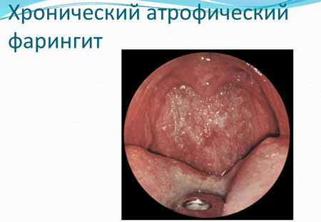 Хронічний фарингіт – симптоми і лікування у дорослих, як лікувати хронічний фарингіт