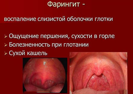 Хронічний фарингіт – симптоми і лікування у дорослих, як лікувати хронічний фарингіт