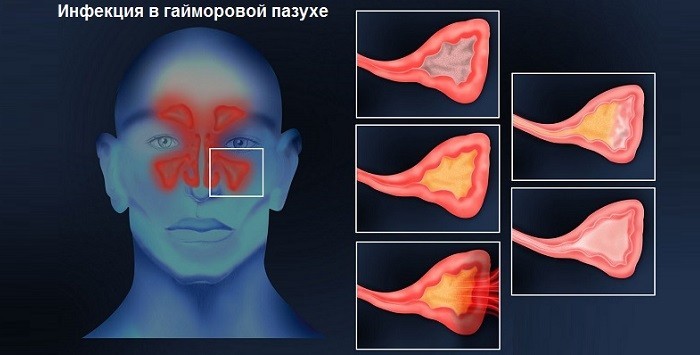 Хронічний гайморит причини симптоми і лікування та профілактика