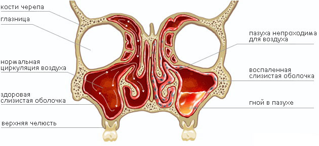 Хронічний гайморит – симптоми, лікування у дорослих і дітей Хронічний гайморит – симптоми, лікування у дорослих і дітей