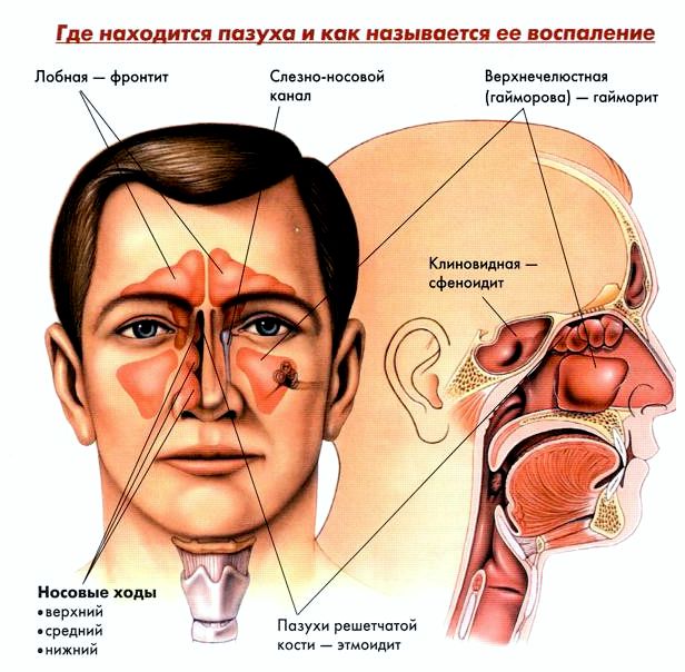 Хронічний гайморит – симптоми, лікування у дорослих і дітей Хронічний гайморит – симптоми, лікування у дорослих і дітей