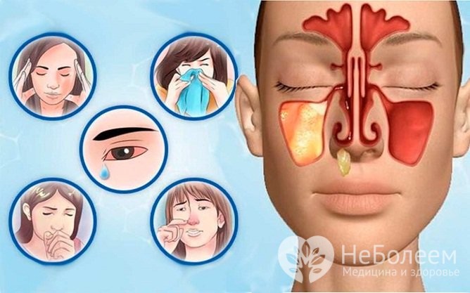 Хронічний гайморит – симптоми, лікування у дорослих і дітей