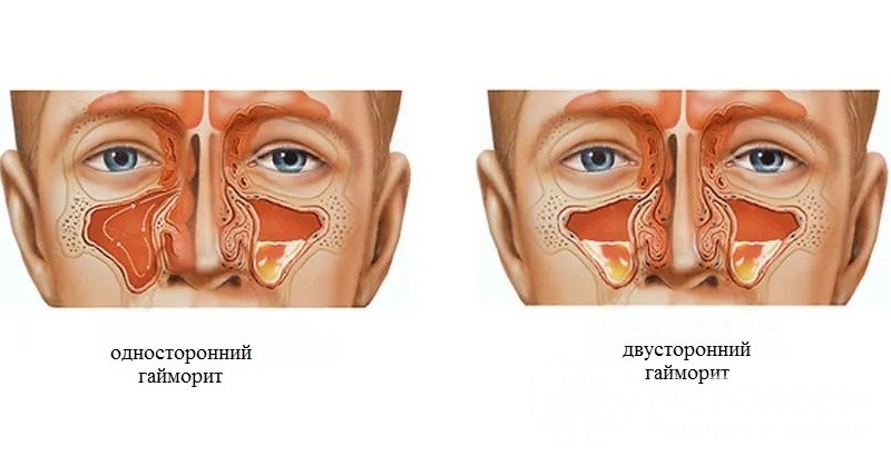 Хронічний гайморит – симптоми, лікування у дорослих і дітей Хронічний гайморит – симптоми, лікування у дорослих і дітей