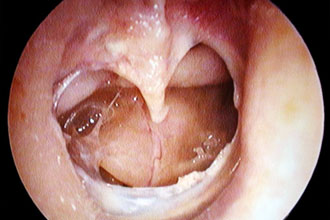 Хронічний гнійний середній отит