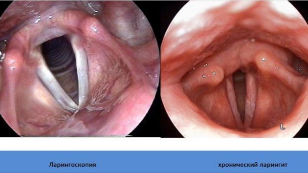Хронічний ларингіт: симптоми і лікування