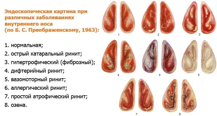 Хронічний нежить причини і лікування