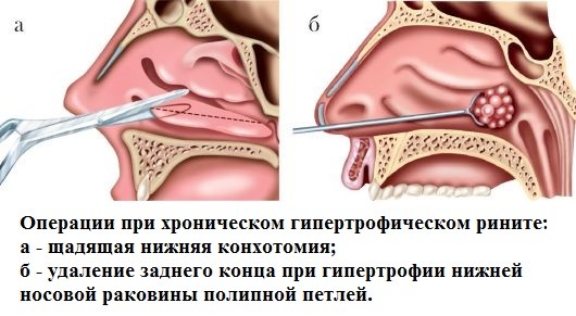 Хронічний нежить причини і лікування