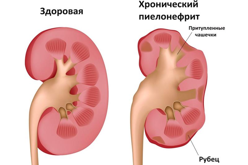 Хронічний пієлонефрит: причини, симптоми, діагностика та лікування
