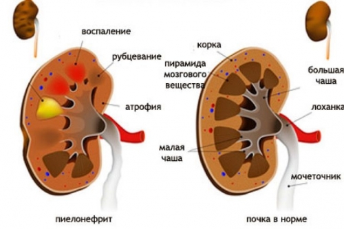 Хронічний пієлонефрит як правильно лікувати