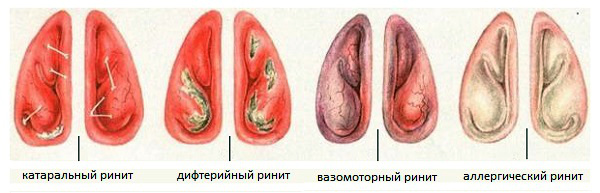 Хронічний риніт: симптоми і лікування нежиті