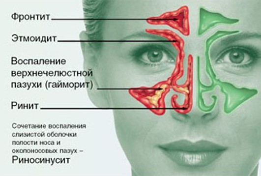 Хронічний риносинусит – симптоми і лікування одностороннього і двостороннього 2019 Хронічний риносинусит – симптоми і лікування одностороннього і двостороннього 2019