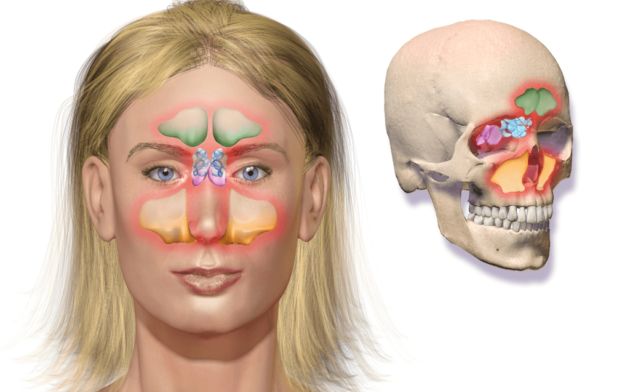 Хронічний риносинусит – симптоми і лікування одностороннього і двостороннього 2019 Хронічний риносинусит – симптоми і лікування одностороннього і двостороннього 2019