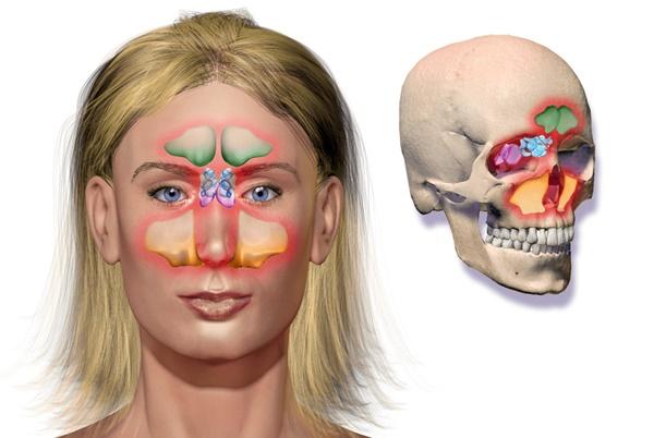 Хронічний риносинусит – симптоми і лікування одностороннього і двостороннього 2019 Хронічний риносинусит – симптоми і лікування одностороннього і двостороннього 2019