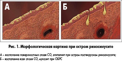 Хронічний риносинусит – симптоми і лікування одностороннього і двостороннього 2019 Хронічний риносинусит – симптоми і лікування одностороннього і двостороннього 2019