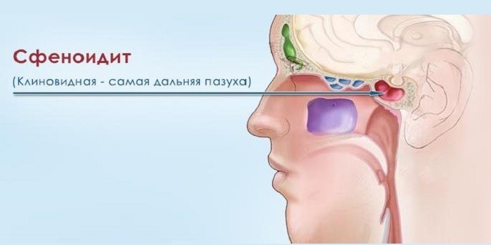 Хронічний сфеноидит – що це таке? Сфеноидит: симптоми, діагностика та лікування